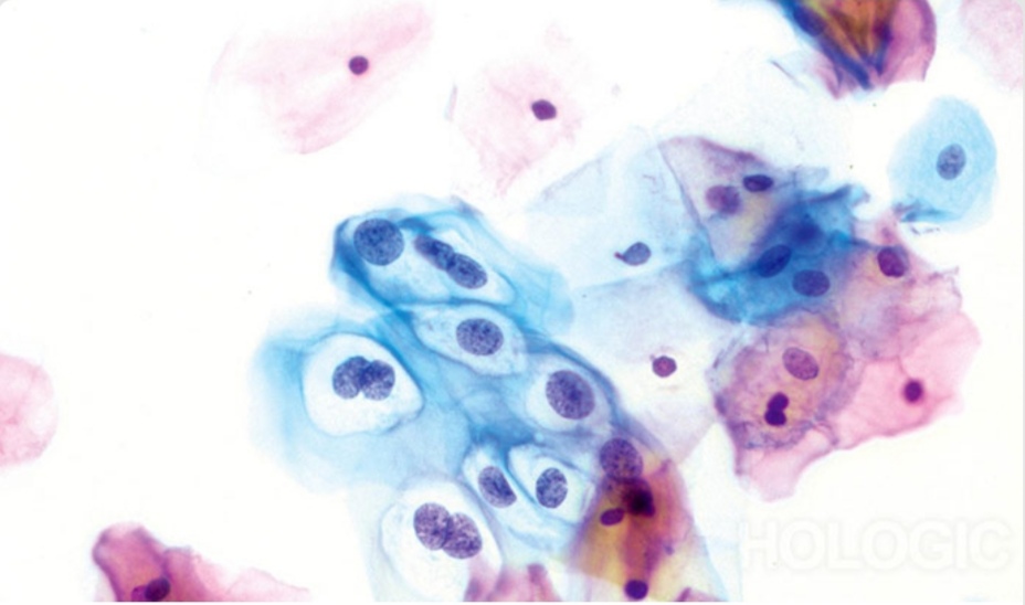 papilloma vírus pozitív biopszia
